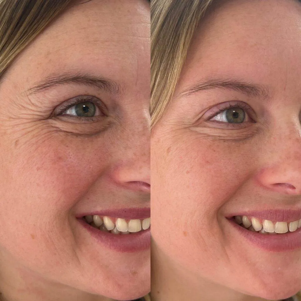 Cheap Botox near me Phoenix Arizona