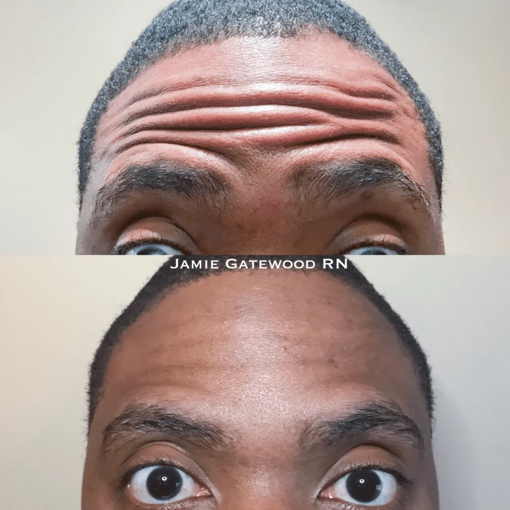 mens Botox near me, mens dermal filler near me in Phoenix