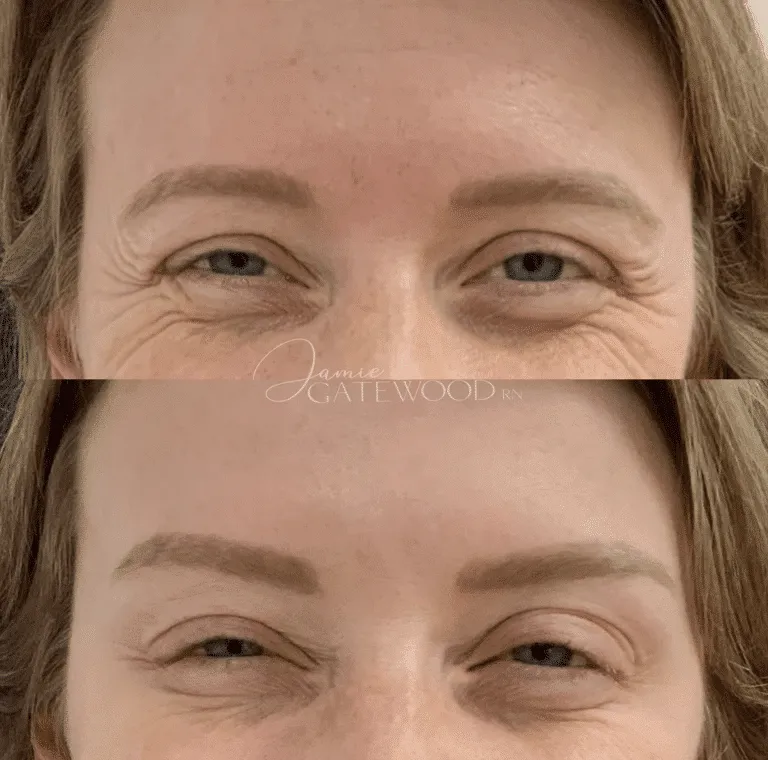 Crow's Feet, Eye Wrinkles