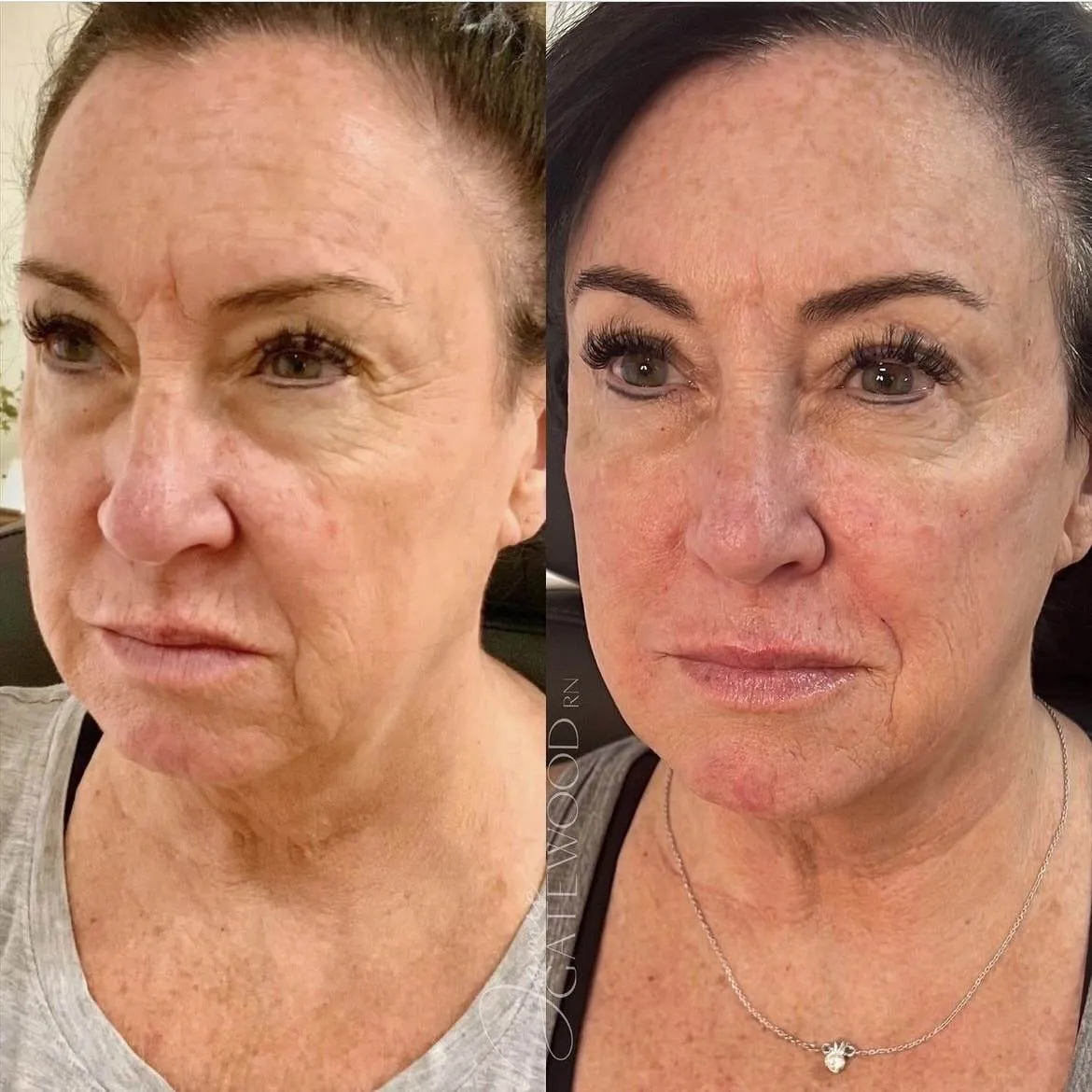 Full-Facial Balancing 6