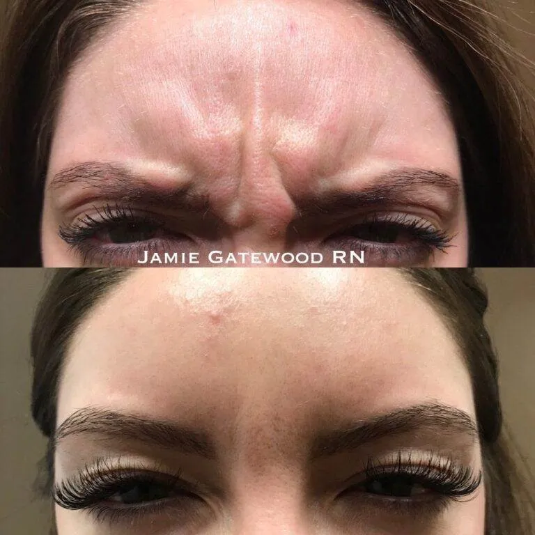 Botox frown lines, Botox glabella, Botox 11's