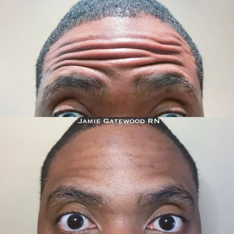 Brotox Dysport Men Forehead Lines Frontalis Wrinkles Forehead Wrinkles