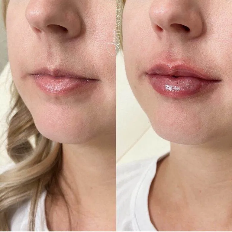 Scottsdale Lip Filler