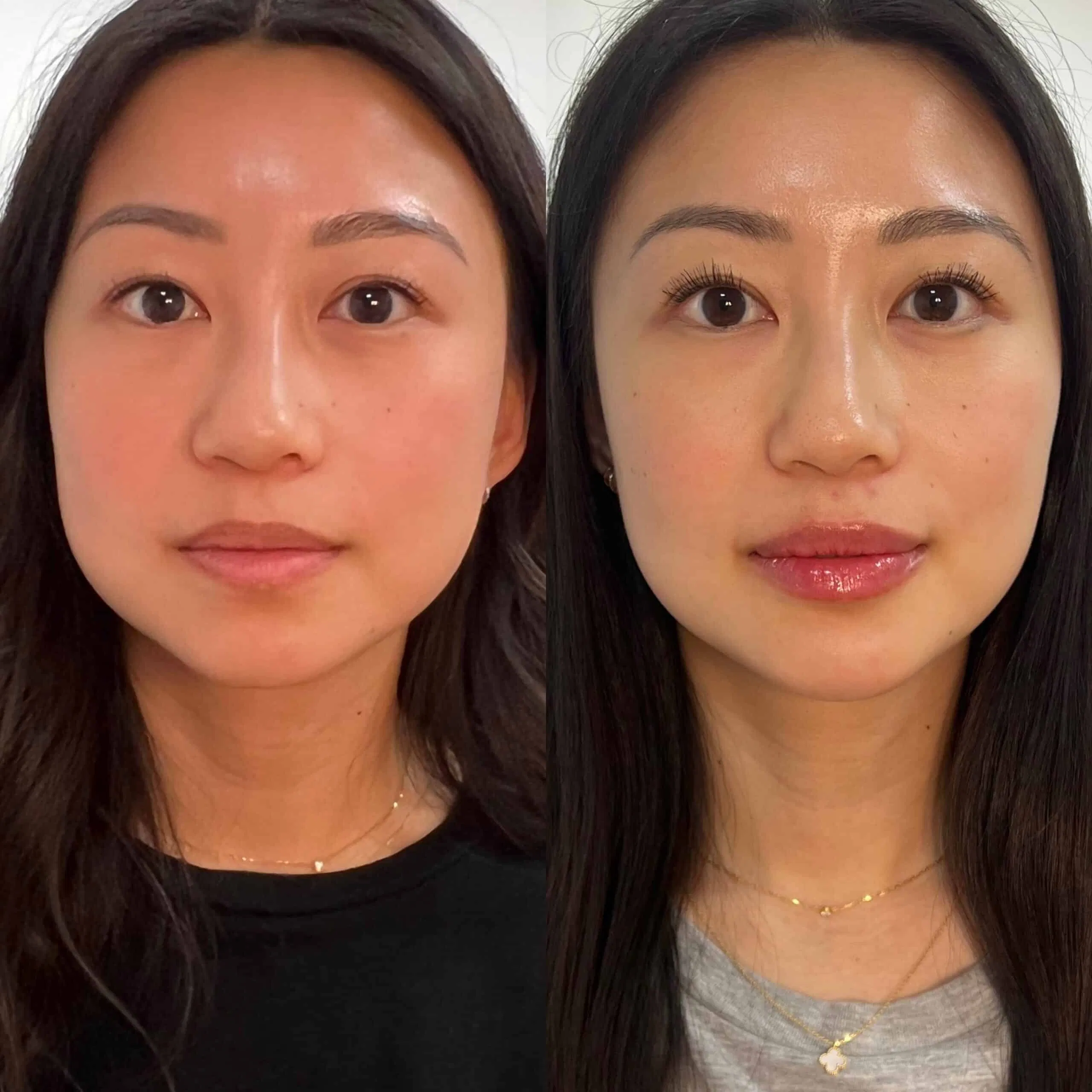 Phoenix masseter Botox, Asian Lip Filler