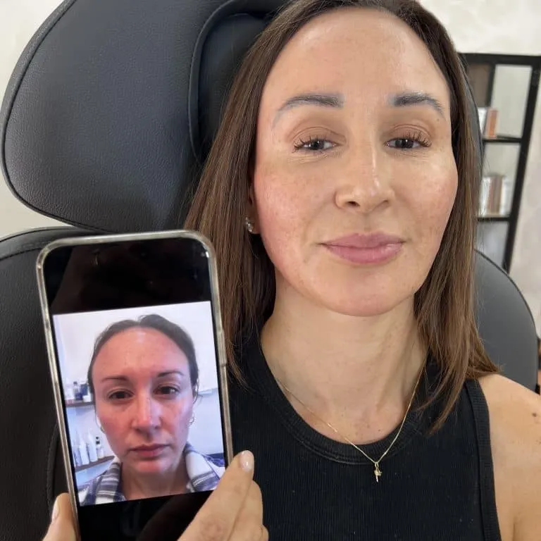 Phoenix Arizona Sculptra to Maintain Youth for Age 40