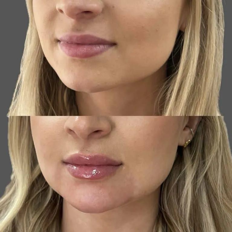 Old Town Scottsdale Blonde Lip Filler