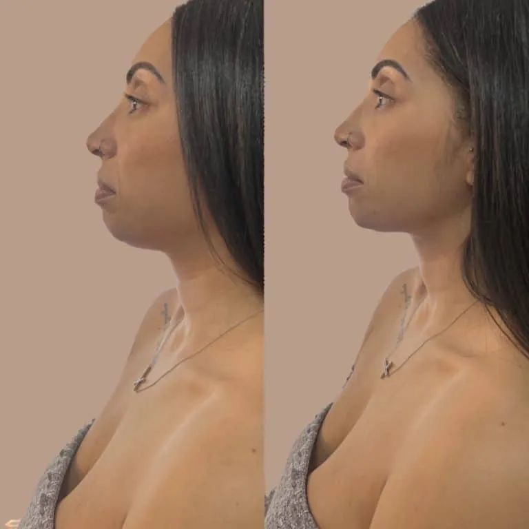 Phoenix AZ weak recessed chin filler