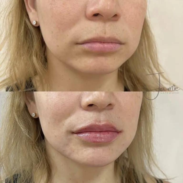 Mesa Arizona Chin Filler and Lip Filler