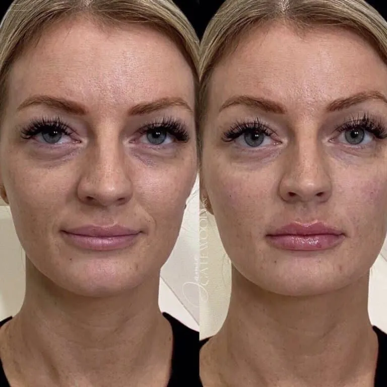 Scottsdale Arizona Filler for Tired Eyes, Smile Lines, and Lips