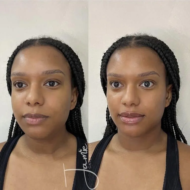 African-American Facial Balancing