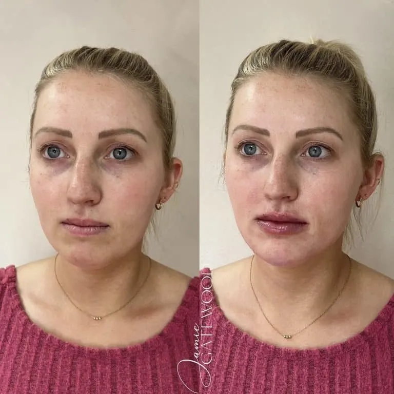 North Scottsdale Facial Harmony