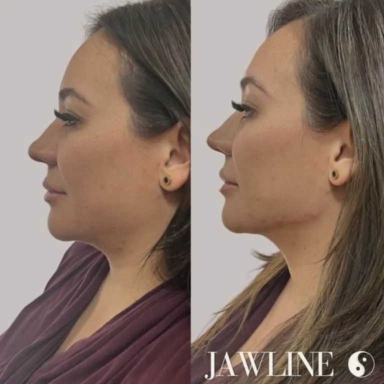 Phoenix Arizona Latina Jawline Filler