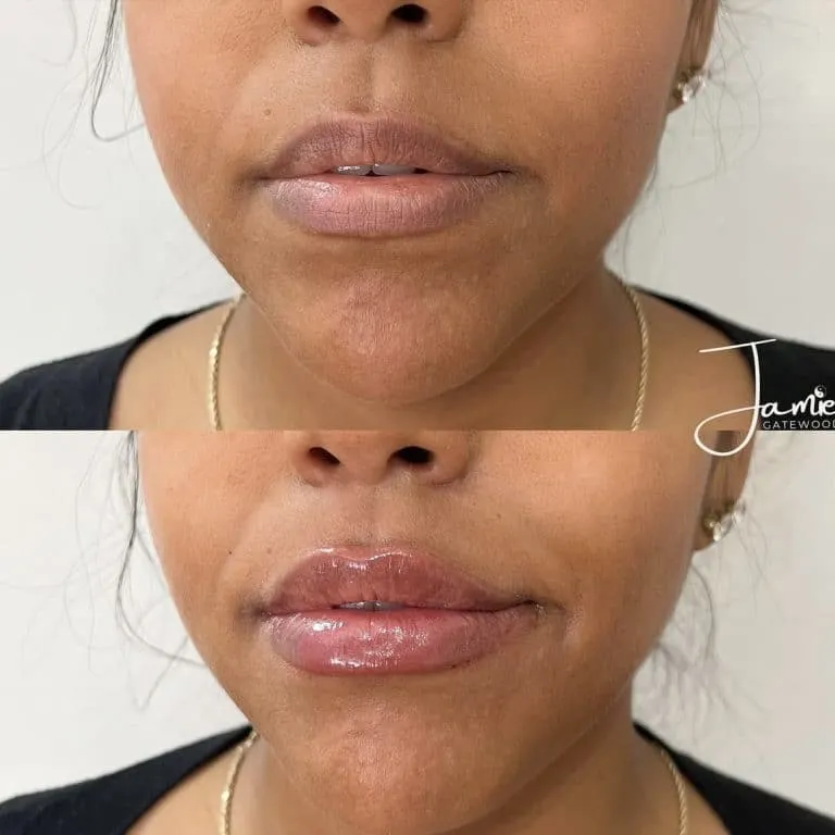 Phoenix AZ Lip Filler for Black Women