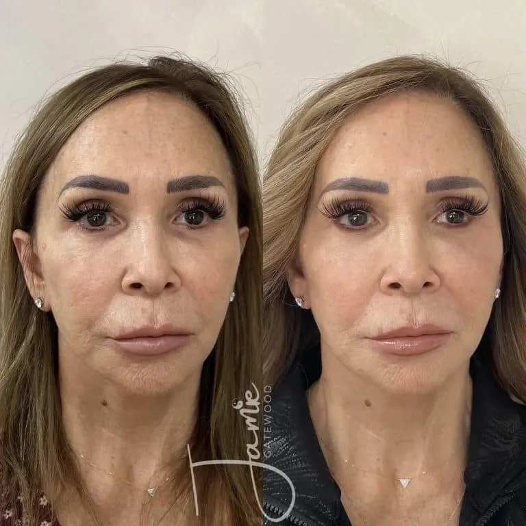 Scottsdale Arizona Sculptra for 60-year-old