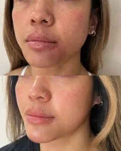 Phoenix Arizona Microneedling Transformation for Pores, Skin Texture, & Skin Tone