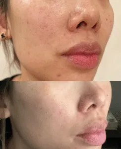 North Phoenix Microneedling Before & After Photo