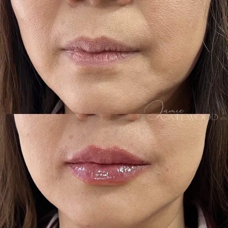 Phoenix Arizona Natural-Looking Lip Filler for Hydration