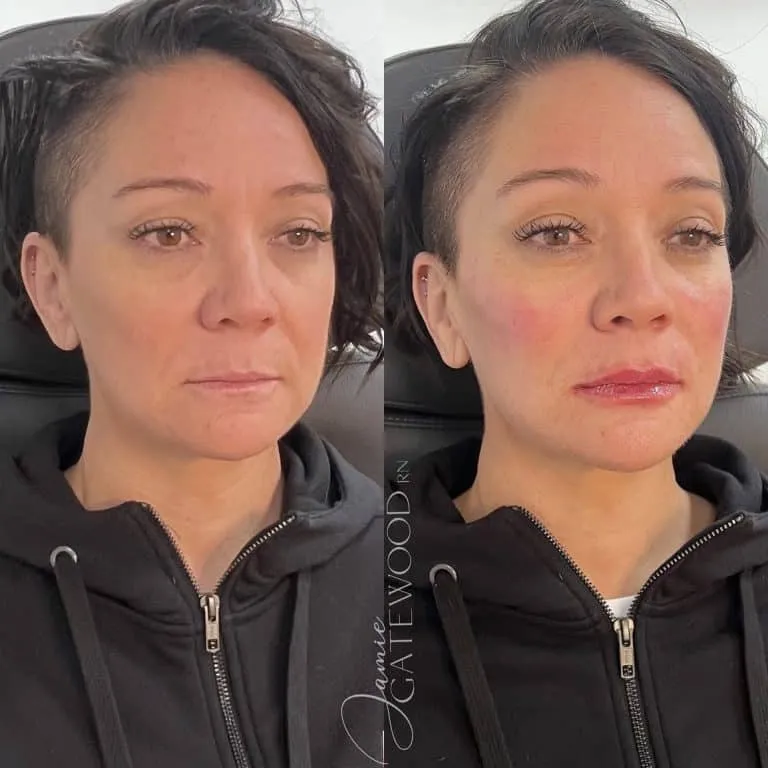 Cave Creek Filler for Volume Restoration Women Age 50