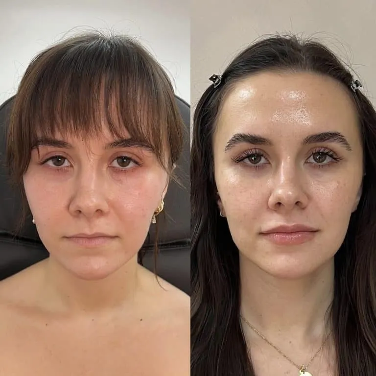 scottsdale arizona prf under-eye treatment for red under-eyes