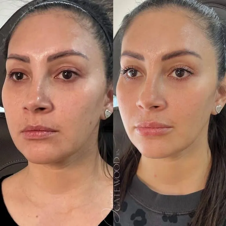 Phoenix Arizona PRF Treatment for Dark Under-Eyes Latina