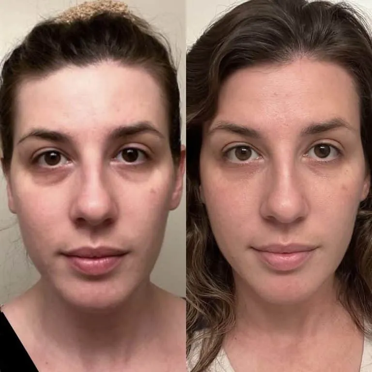 Chandler Arizona Under-Eye Filler