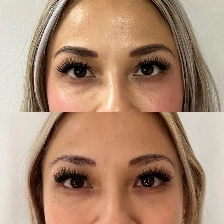 phoenix az prf asian eyes