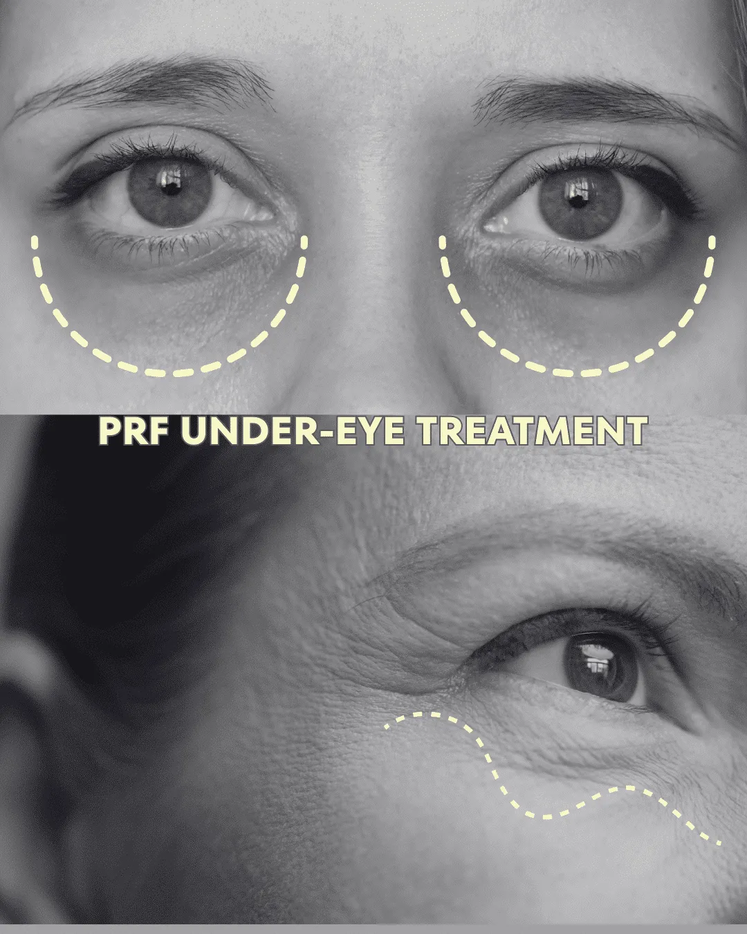 phoenix arizona prf under-eye injections for dark and thin skin